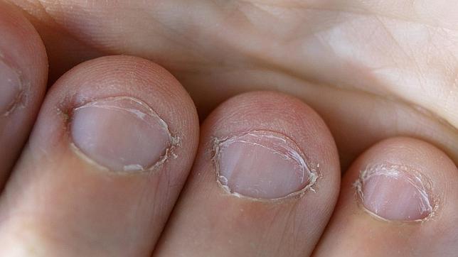 Los dedos de una persona que se muerde las uñas se deforman