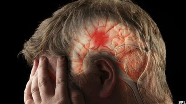 El sistema de salud pública británico, el NHS, estima que una de cada cuatro personas que sufren un derrame cerebral mueren. El sistema de salud pública británico, el NHS, estima que una de cada cuatro personas que sufren un derrame cerebral mueren.