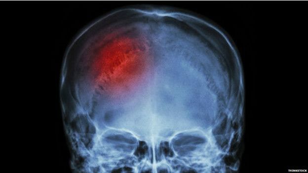 La hipertensión es uno de los principales factores de riesgo de un derrame cerebral. La hipertensión es uno de los principales factores de riesgo de un derrame cerebral.