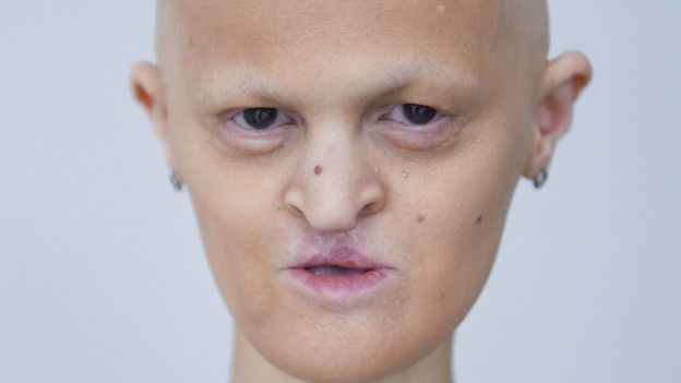 Melanie Goydos es única hasta en su tipo de anomalía genética, y quizás esa sea la razón por la que su aspecto es tan llamativo.