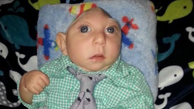 Muchos de los bebés que nacen con la enfermedad de Jaxon mueren a pocas de su nacimiento. Muchos de los bebés que nacen con la enfermedad de Jaxon mueren a pocas de su nacimiento.