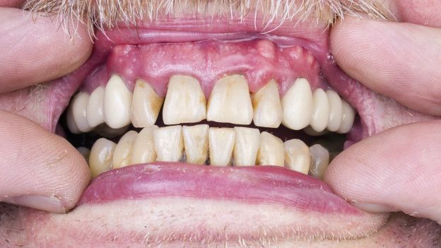 Hay algunos alimentos y bebidas que oscurecen y manchan nuestros dientes. Hay algunos alimentos y bebidas que oscurecen y manchan nuestros dientes.