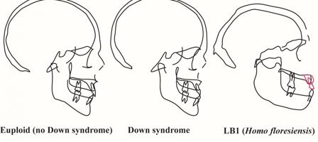 Perfiles de cráneos en personas con y sin síndrome de Down- Karen Baab Perfiles de cráneos en personas con y sin síndrome de Down- Karen Baab