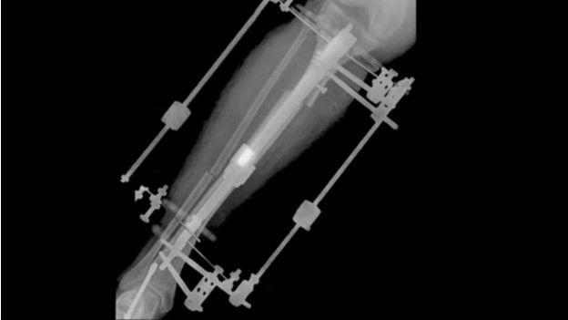 El dispositivo fijador externo permite alargar la tibia un milímetro al día. El dispositivo fijador externo permite alargar la tibia un milímetro al día.