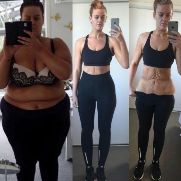 Simone Anderson empezando su proceso y antes de someterse a la abdominoplastia. Simone Anderson empezando su proceso y antes de someterse a la abdominoplastia.