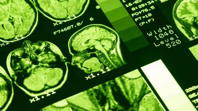 Muchas de las evaluaciones se realizaron mediante resonancias magnéticas de los cerebros. Muchas de las evaluaciones se realizaron mediante resonancias magnéticas de los cerebros.