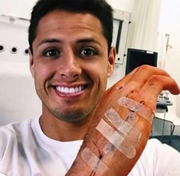 Así quedó la mano de “Chicharito” Hernández tras la cirugía. Estará dos semanas inactivo