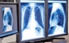 El paciente se contagió hace poco más de dos meses y sus pulmones sufrieron daño irreversible