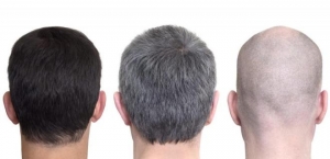 Un joven con canas prematuras, junto a otro que no sufre este problema.
