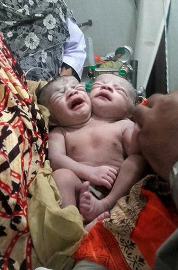 Una niña con dos cabezas conmociona a Bangladesh