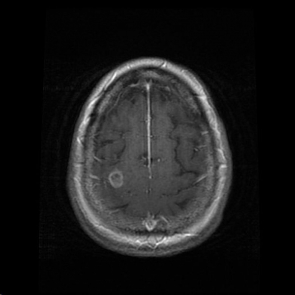 Una mujer muere por las amibas que le comieron el cerebro tras un lavado nasal