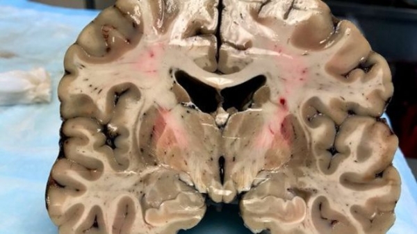 A pesar de su apariencia saludable exterior, el cerebro de Hernández estaba profundamente dañado por la encefalopatía traumática crónica.