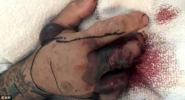 Un hombre casi muere por la mordedura de una serpiente que acababa de decapitar