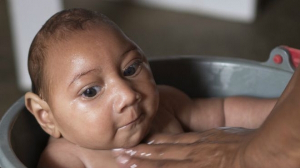 Los expertos están investigando los vínculos entre el virus del zika y la microcefalia.