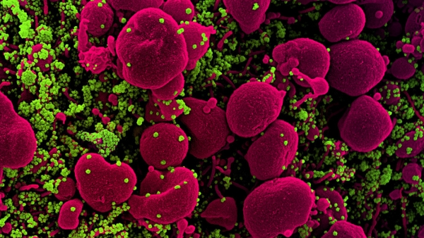 Imagen de una célula apoptótica infectada con partículas de coronavirus, tomada de la muestra de un paciente.