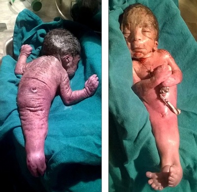 Nace en la India un niño con el &#039;síndrome de la sirena&#039;