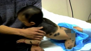 El obrero Zhang Daojiang y su esposa están consternados por la salud de su hijo, que padece la rara enfermedad de la piel llamada nevus congénito gigante