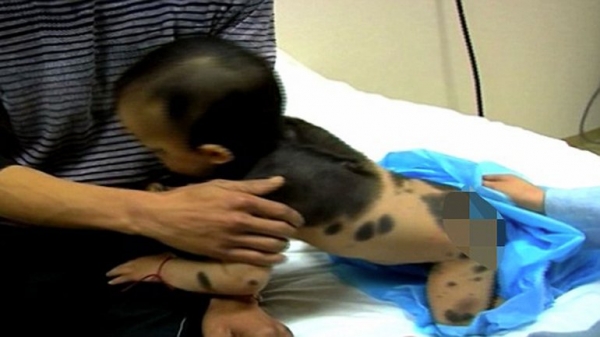 El obrero Zhang Daojiang y su esposa están consternados por la salud de su hijo, que padece la rara enfermedad de la piel llamada nevus congénito gigante