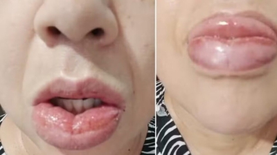 Dejarán de fabricar una pasta dental Colgate después de miles de denuncias por reacciones adversas