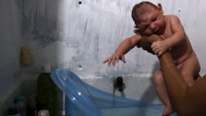 Juan Pedro, de dos meses, nació con microcefalia en Recife, Brasil