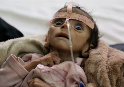 85.000 niños muertos en Yemen por hambre y enfermedades debido al bloqueo saudí